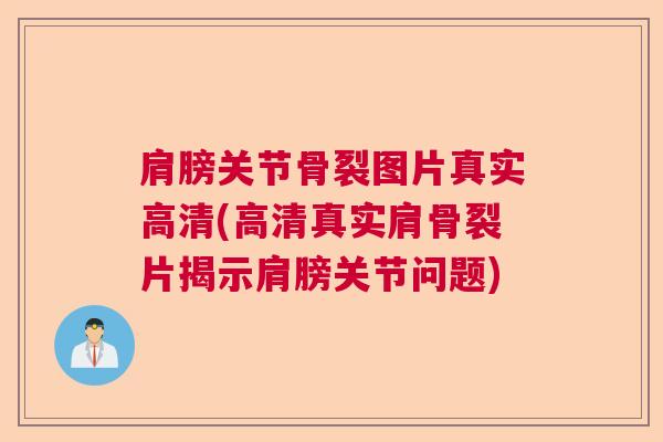 肩膀关节骨裂图片真实高清(高清真实肩骨裂片揭示肩膀关节问题)