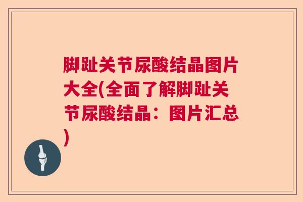 脚趾关节尿酸结晶图片大全(全面了解脚趾关节尿酸结晶:图片汇总) 脚趾关节尿酸结晶图片大全(全面了解脚趾关节尿酸结晶:图片汇总)
